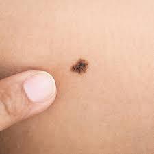 skin-cancer-example