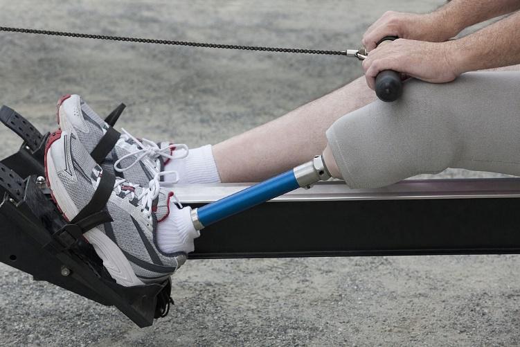 Obtaining Custom Prosthetics in Utah to Match Your